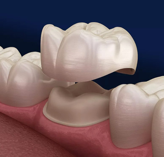 Restorative Dentistry -Pearl dentistry of South Hills