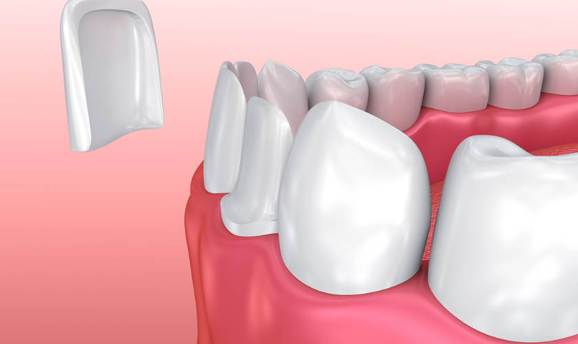 Dental Veneers Trends