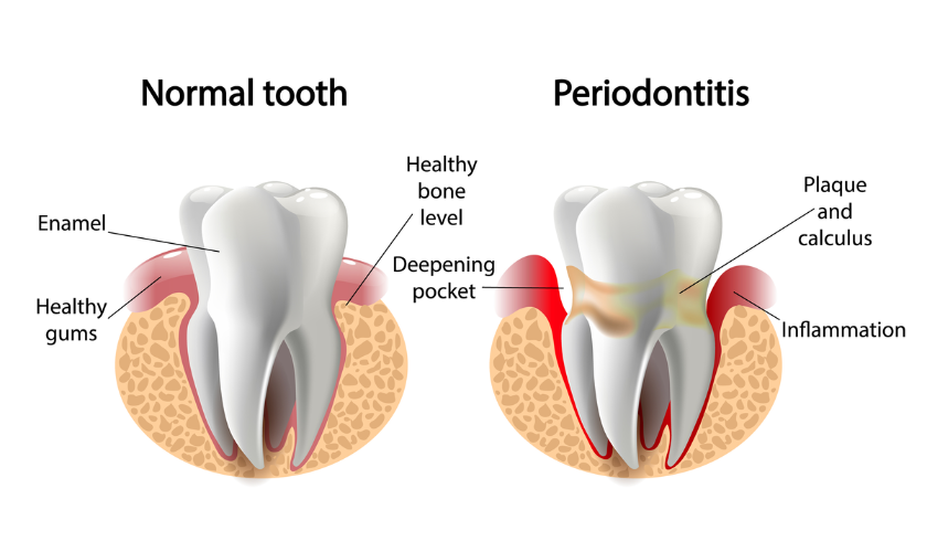 Gingivitis Progresses to Periodontitis