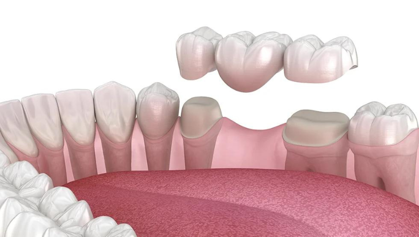Do Dental Crowns Fall Under Cosmetic Dentistry