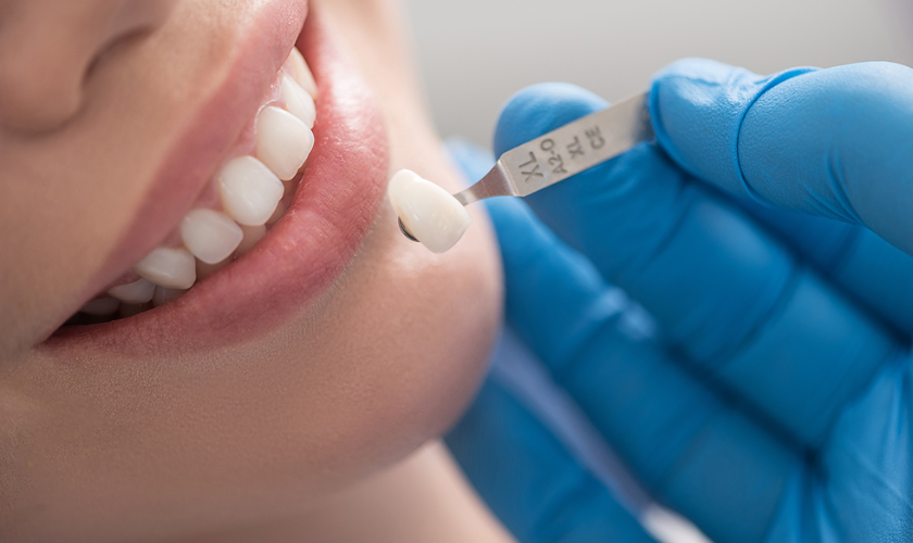 Dental Veneers for Your Smile Makeover