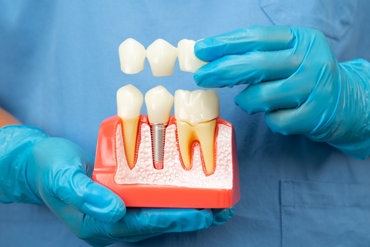 dental-implants-in-South-Hills